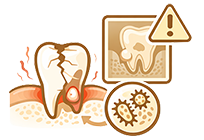 Хроническое воспаление